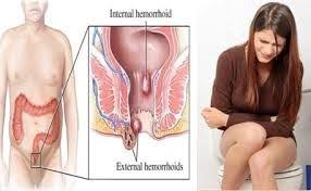 Jual Ambejoss Salep Salwa Obat Wasir De Nature Di Waropen