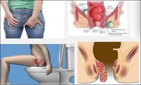 Jual Ambejoss Salep Salwa Obat Wasir De Nature Di Serang