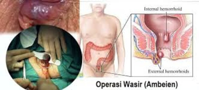 Jual Ambejoss Salep Salwa Obat Wasir De Nature Di Parepare